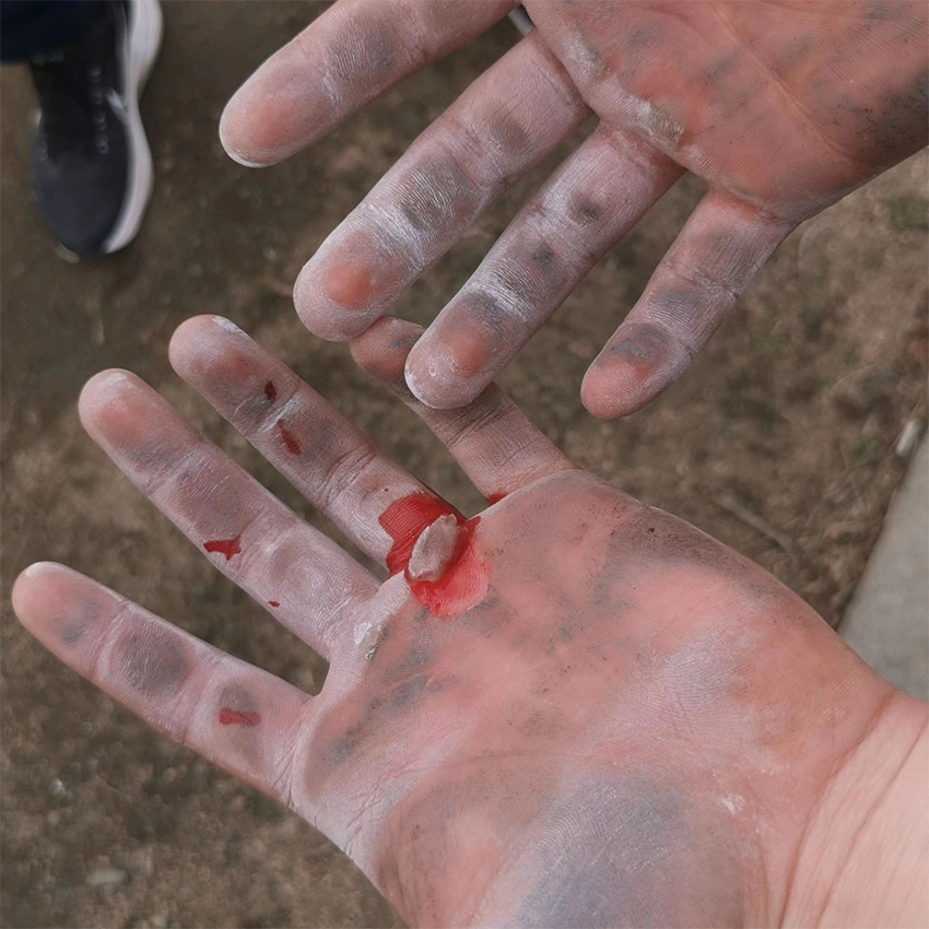 消防战士的受伤的手图片