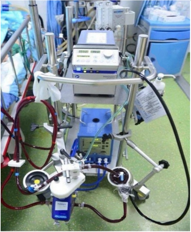 郑医感控自习室第五期丨ecmo技术及感染风险