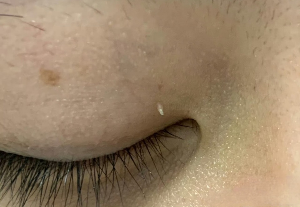眼皮上的丝状疣,可以这样处理