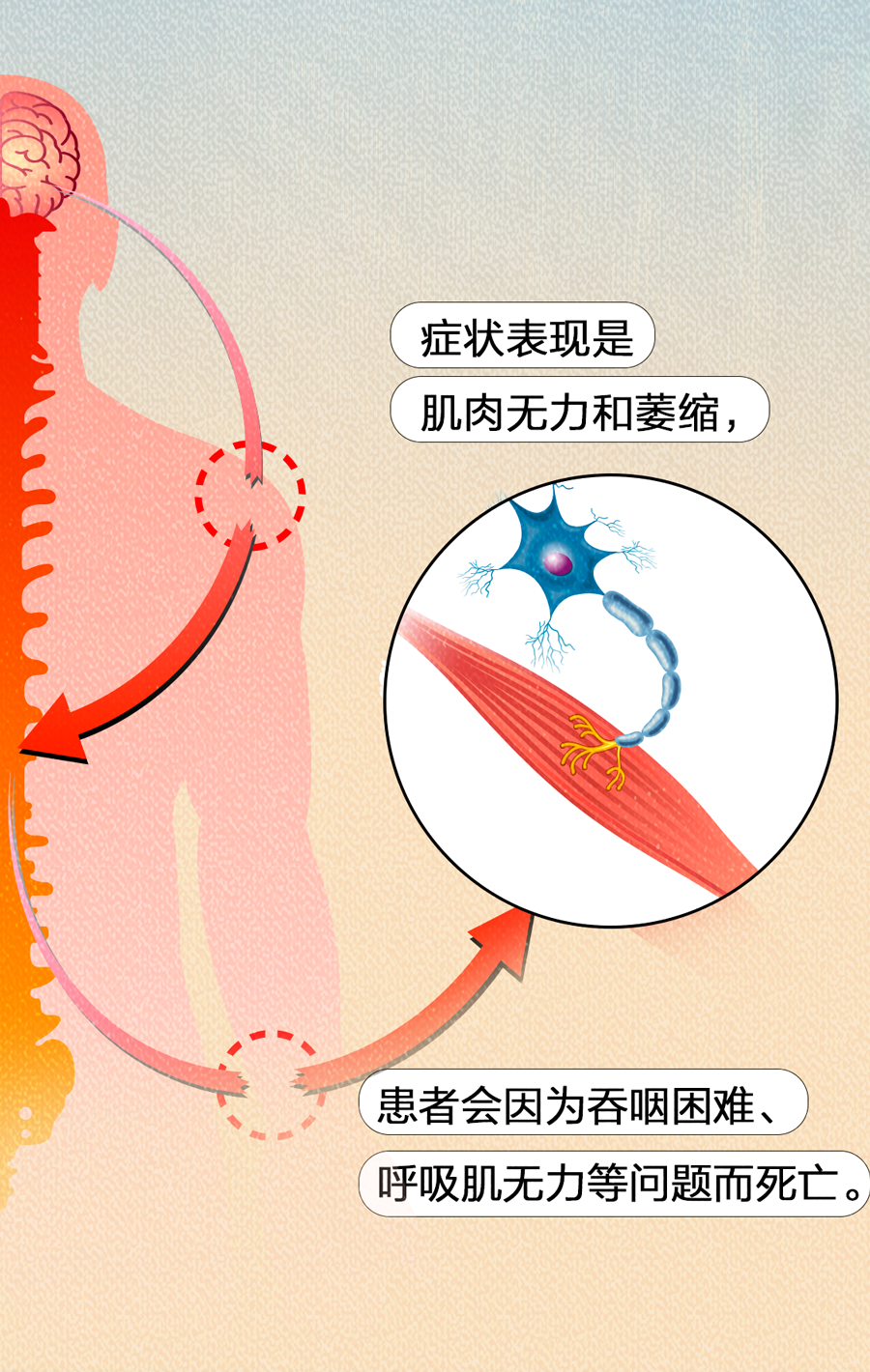 渐冻症遗传吗图片