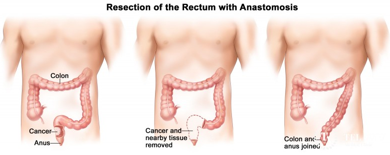 低位直肠癌,保肛,还是保命?如何保肛?-腾讯新闻