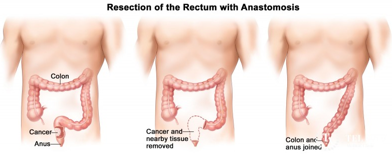 直肠癌挖肛手术图解图片