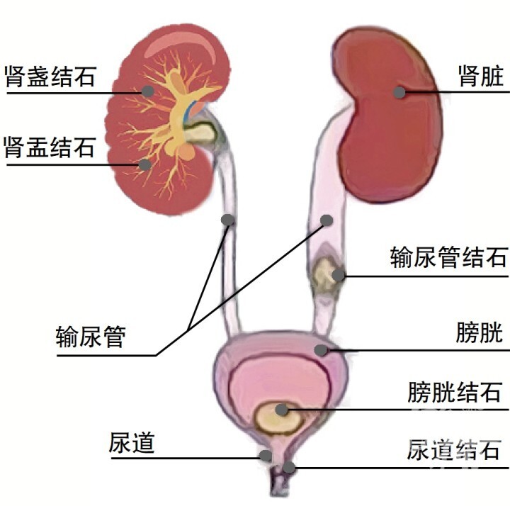 尿路结石的治疗主要有排石治疗,体外冲击波碎石,输尿管镜碎石取石,经