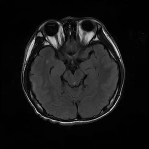 基于宏基因组二代测序快速诊断儿童人细小病毒b19脑膜炎_腾讯新闻