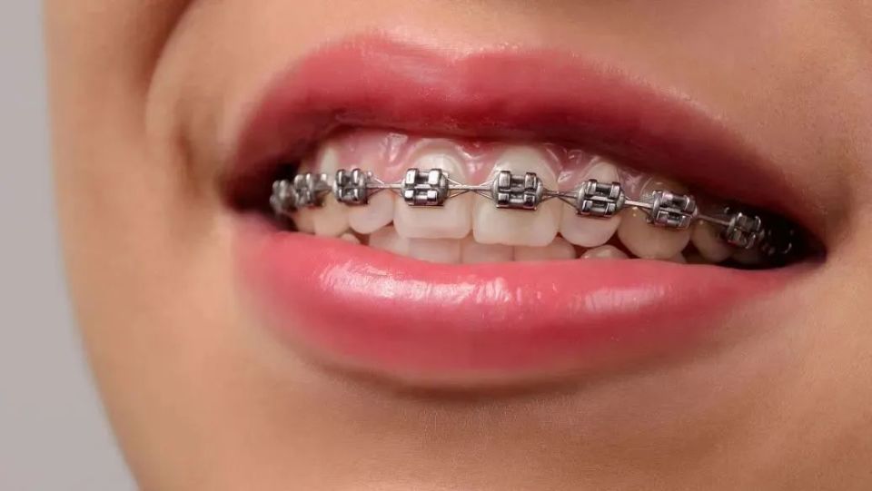 "世界正畸健康日"义诊 | 传统钢丝牙套vs隐形牙套,听听专家怎么说