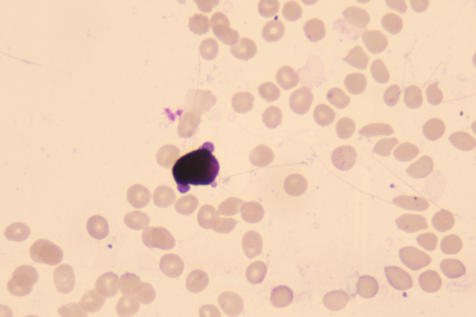 血常规用什么仪器检查患者入院要求弃胎，万万没想到血常规竟隐藏了 1 个致命信号！_https://www.jmylbn.com_新闻资讯_第4张