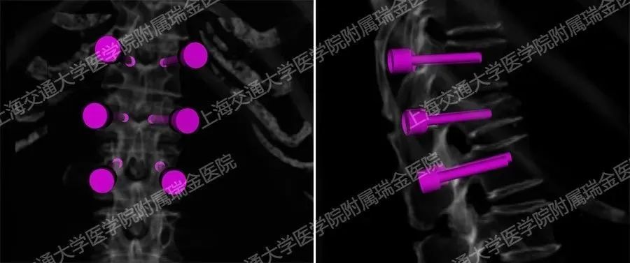 首例国产脊柱手术机器人，成功完成临床试验_腾讯新闻
