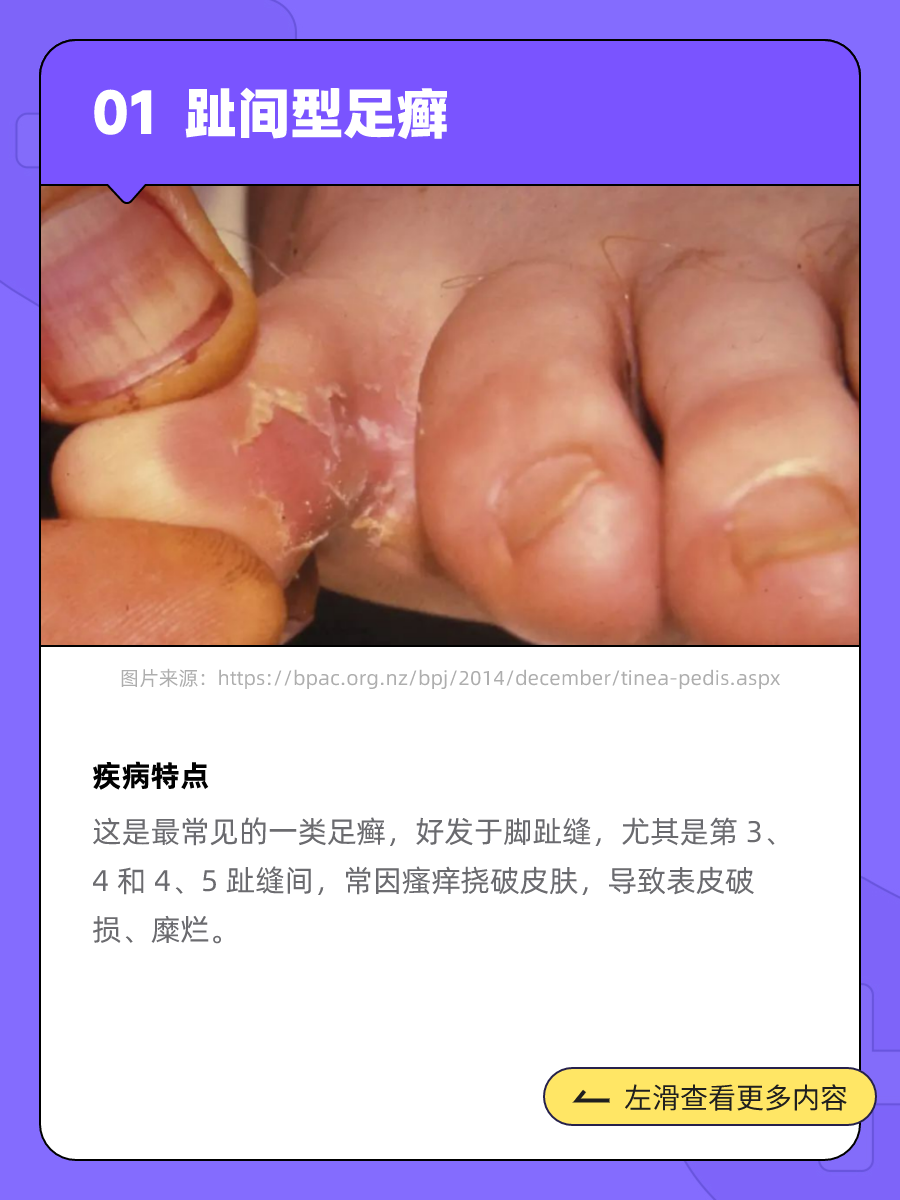 为什么我劝你马上开始治脚气