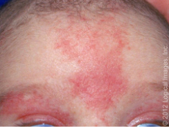 每年数以万计新生儿出现这种「红色胎记」,治疗要趁早!