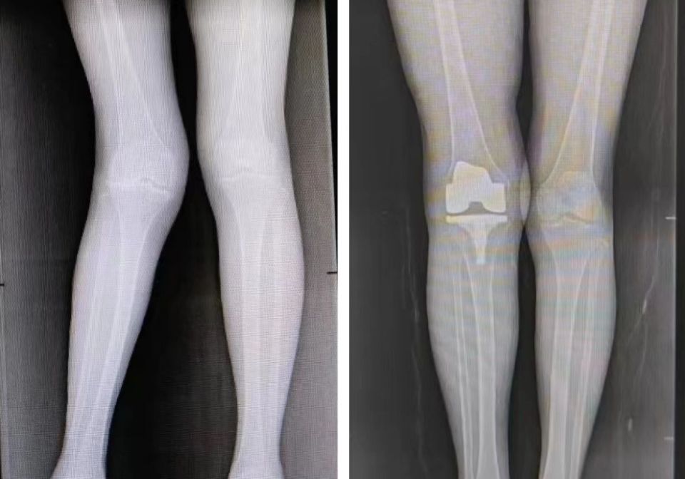 术前术后对比,右膝关节外翻畸形已矫正膝关节外翻畸形已矫正,常规关节