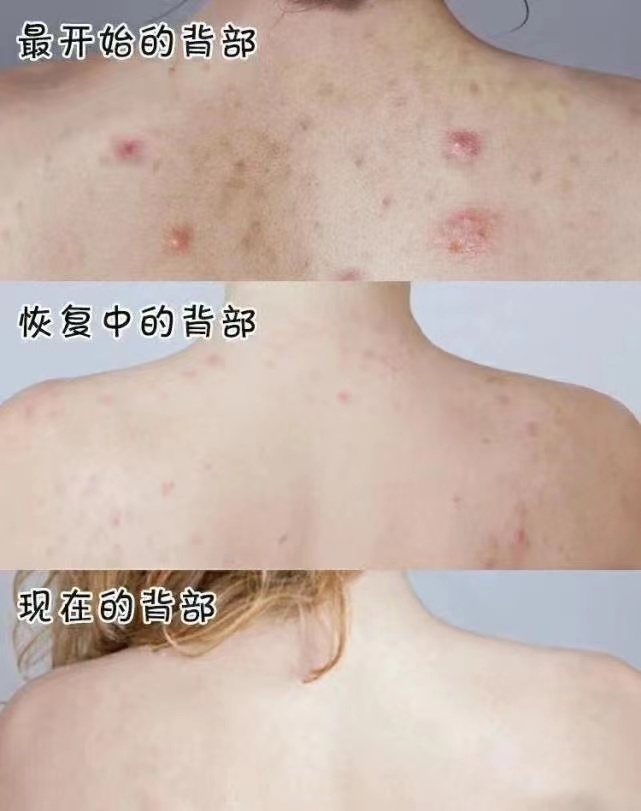 皮肤瘙痒捅了螨虫窝过来人支招在家随便一洗皮肤光滑又健康