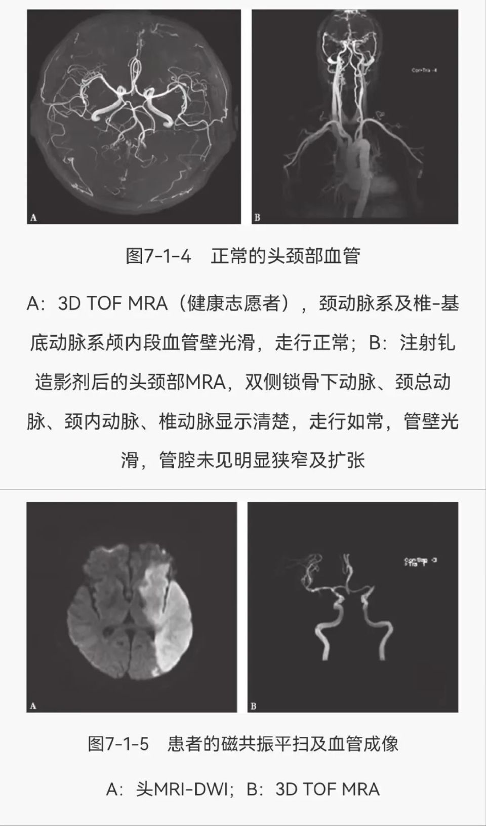 不同脑血管疾病的影像图鉴,值得收藏!