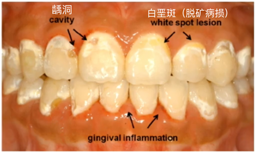 牙齿釉面横纹图片图片