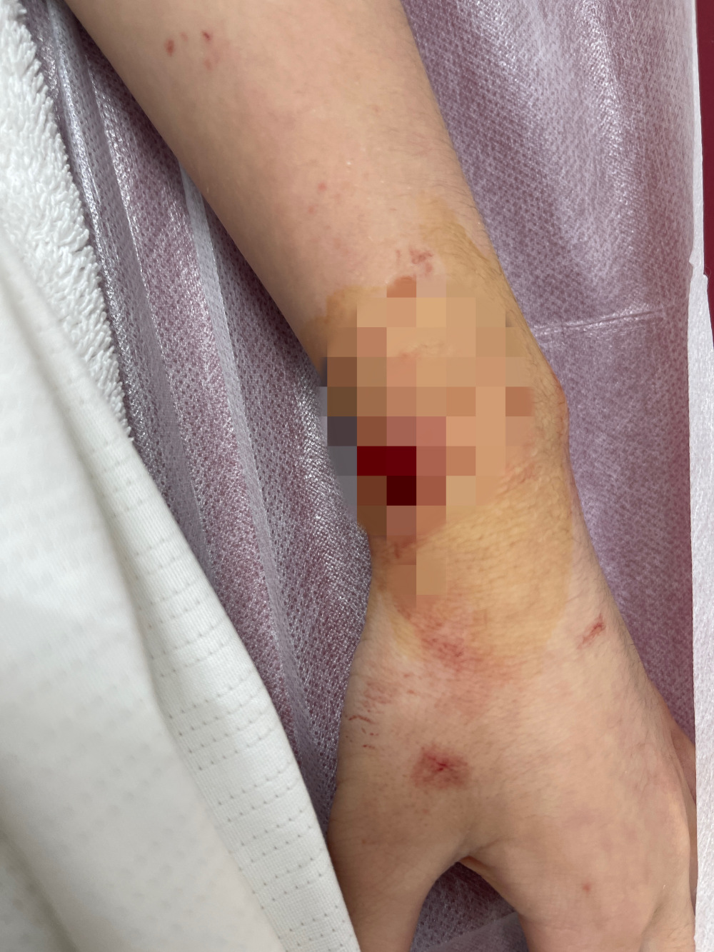 昆明一酒店浴室玻璃自爆致8岁男童浑身玻璃渣?回应:皮外伤,缝了几针