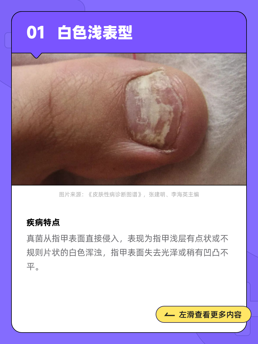 灰指甲不治疗会怎么样?会自己好起来吗?