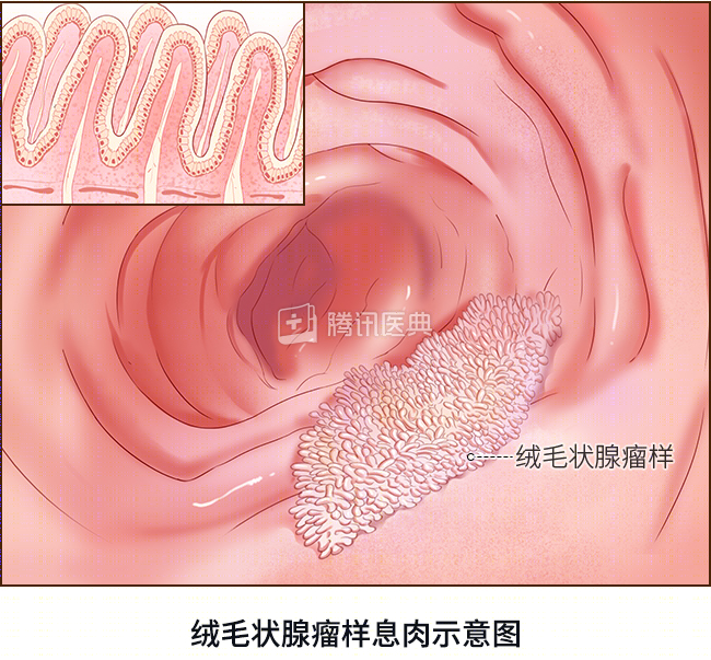 体检发现息肉,离癌有多远?