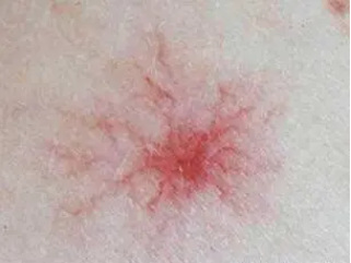 是红疹还像"蜘蛛网"一样扩散开到今年春天还没治好李先生去年春天长出