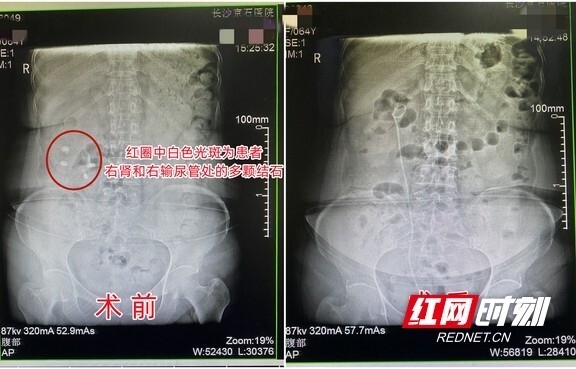 娭毑結石頻發卻堅持保守治療腰痛不止就醫方知右腎岌岌可危