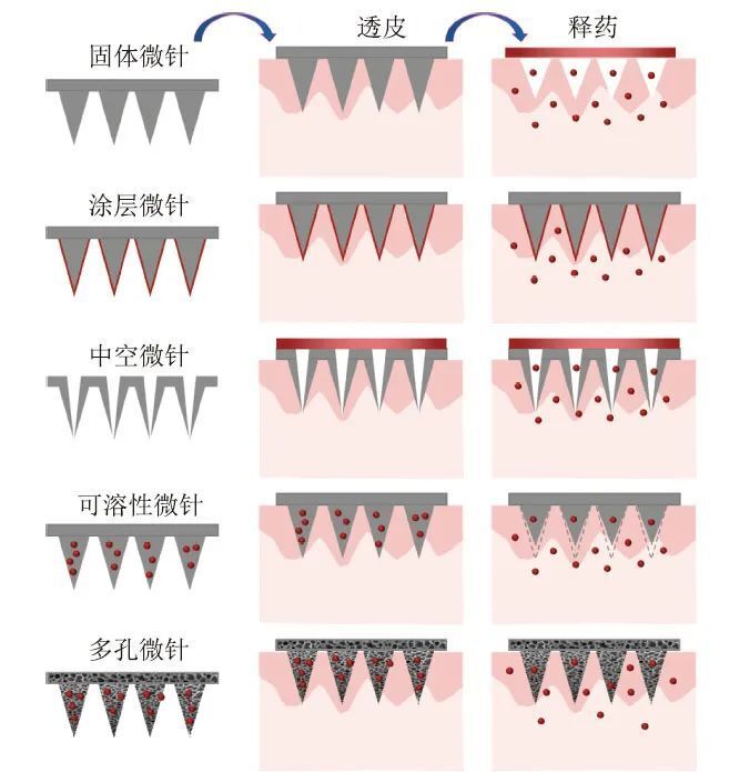朱锦涛教授团队:生物医用微针与经皮诊疗
