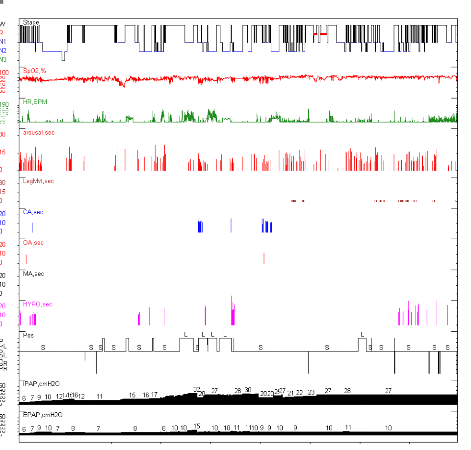 呼吸机怎么打开Ⅱ型呼吸衰竭又陷诊断困局……当室速撞上呼吸“牢笼”，如何通过破解隐匿的神经肌肉密码打开思路，拨云见日？丨疑案探密（161）_https://www.jmylbn.com_新闻资讯_第3张
