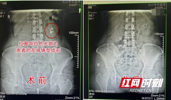 女子患腎結石卻不以為意5年後小黃豆竟長成生薑巨石