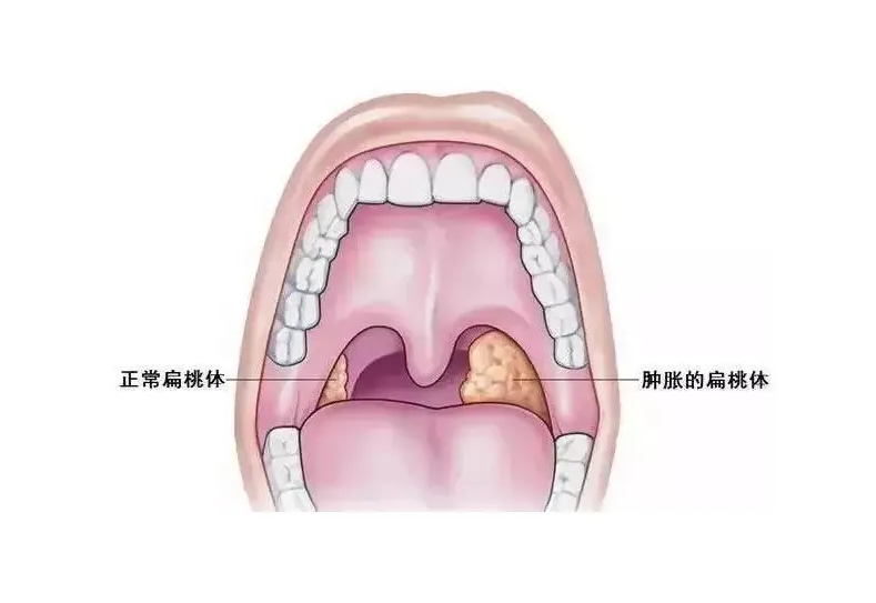 腭扁桃体咽扁桃体图片