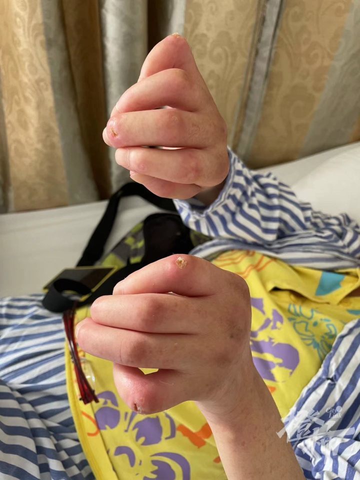 杭州60岁大姐脸上皱纹消失不见,体内胶原蛋白爆满,却苦不堪言