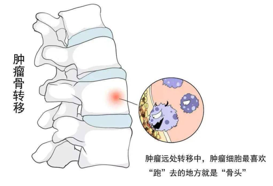 臨床上常見的包括骨髓炎,骨結核,骨腫瘤等骨骼本身病變引起的病理性