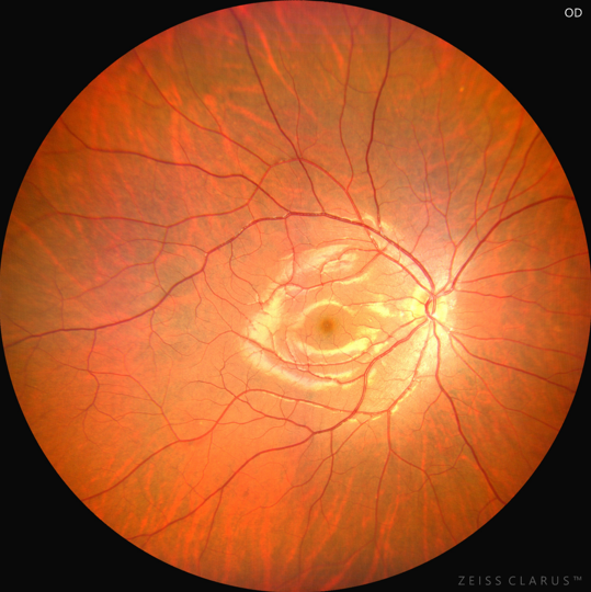 睛彩眼科引进的蔡司clarus 500超广角眼底相机真的很强大-腾讯新闻