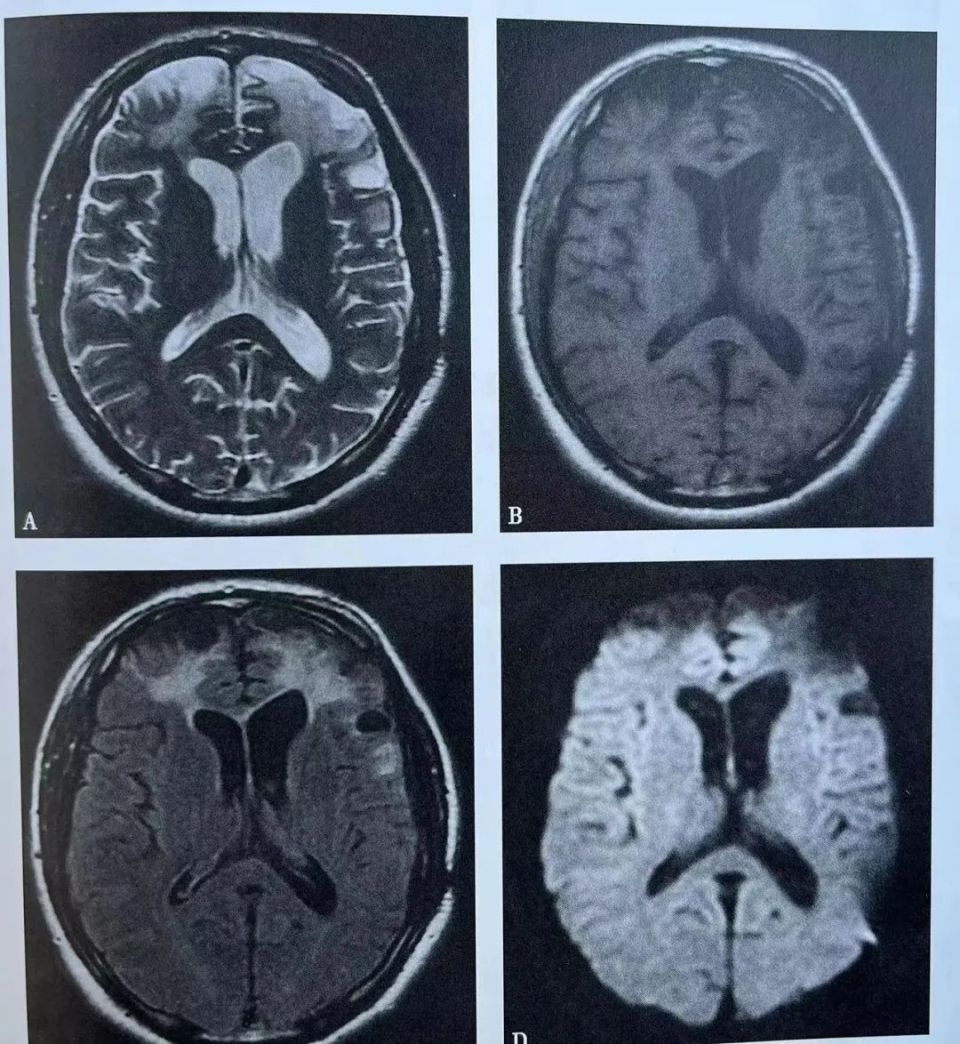 局限性脑萎缩的分类及影像学表现