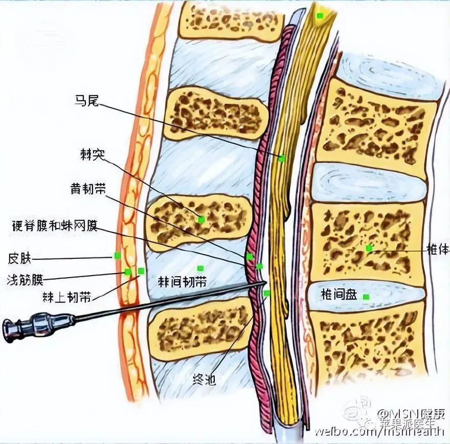 腰椎蛛网膜图片