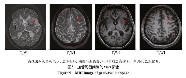 中国脑小血管病的神经影像学诊断标准及名词标准化定