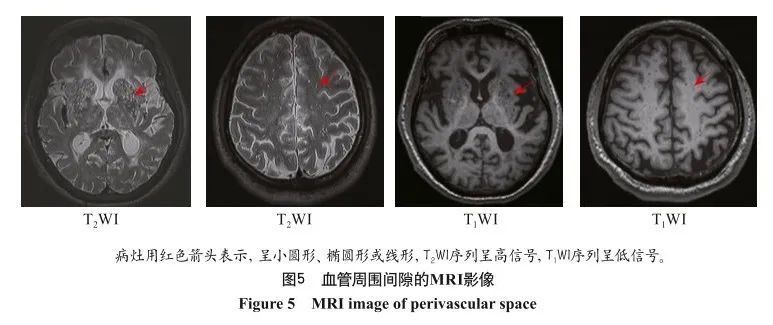中国脑小血管病的神经影像学诊断标准及名词标准化定义——来自中国