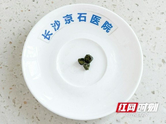 女子查出胆囊结石8年未理 不料哺乳期过度进补突然"引爆"结石