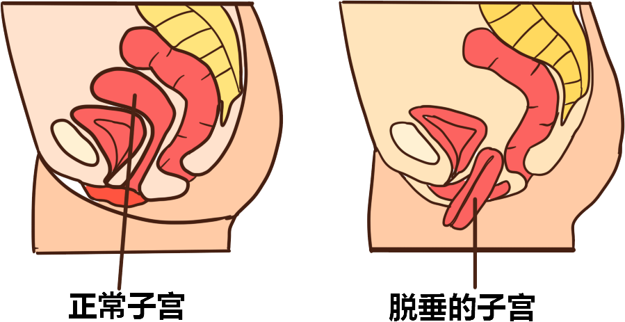 子宫托正确放置位置图图片