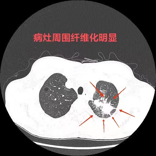 肺放线菌病是间质性肺炎(无论在肺泡或支气管,都会与氧气充分接触