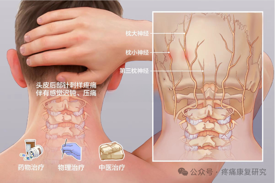 有一种头痛,叫枕神经痛!可以这样诊断和治疗