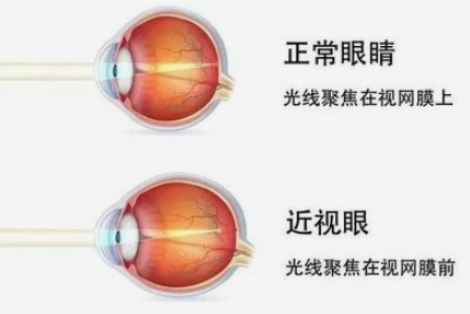 眼的各种结构后,并不能落在视网膜上,而是落在视网膜之前,就称为近视