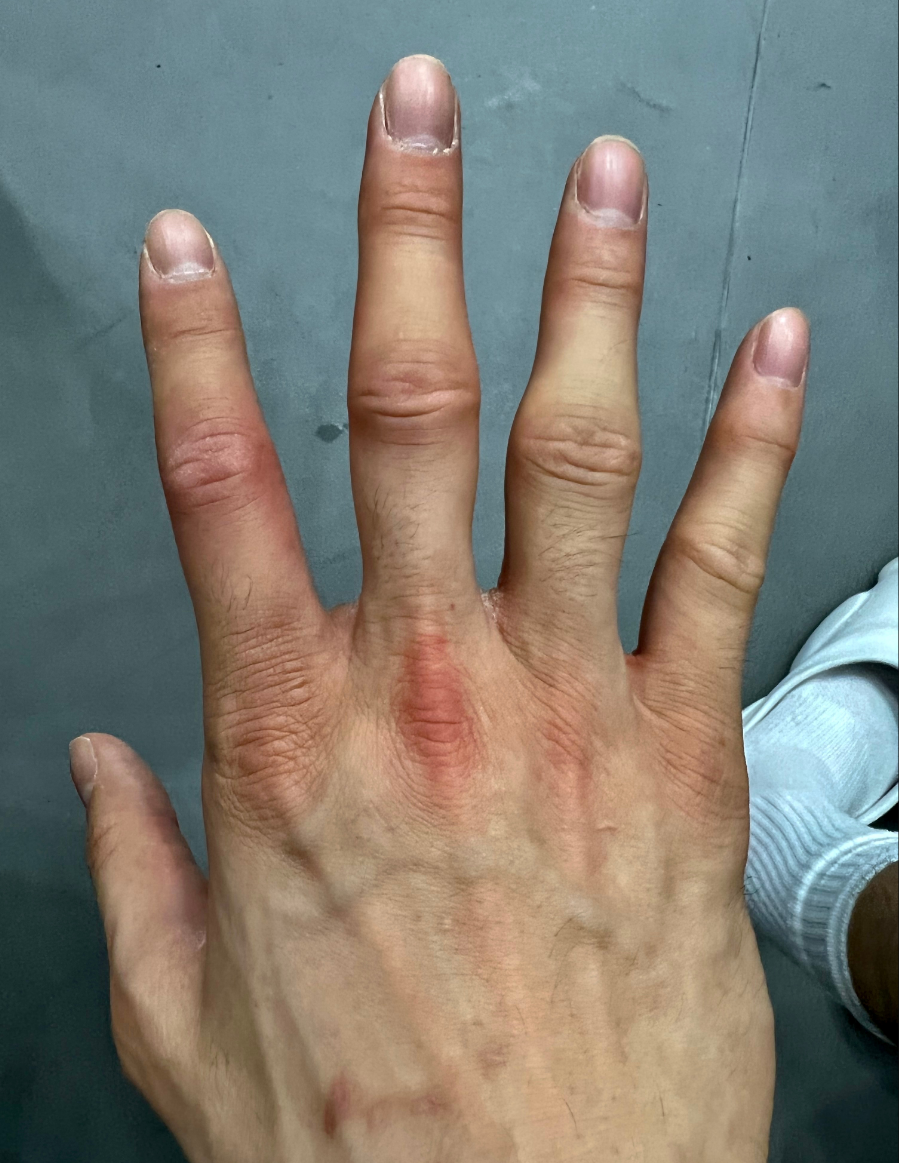 心疼郭艾伦父亲替他按摩肿胀手指艾伦疼得跺脚爸你不知道有多疼