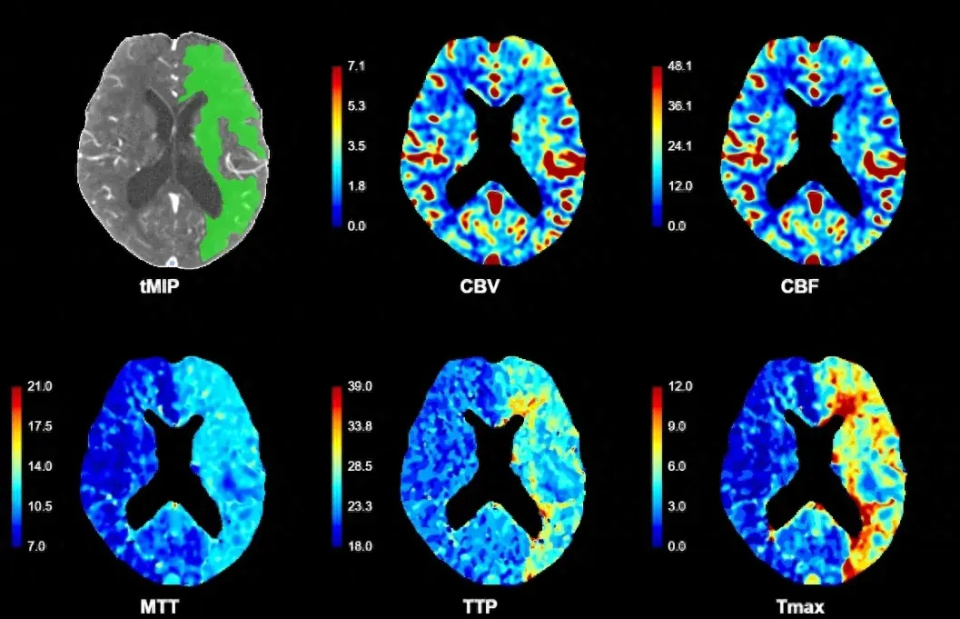 关于什么是ct脑灌注成像?你一定要知道这些知识!