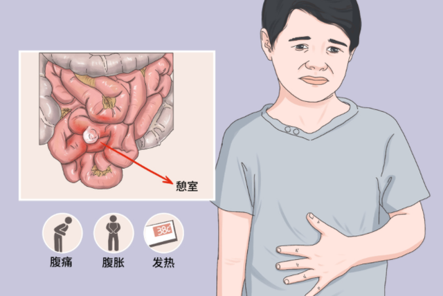 症状,其中仅约8%-22%会出现憩室炎症,溃疡,出血,肠穿孔和肠梗阻等临床
