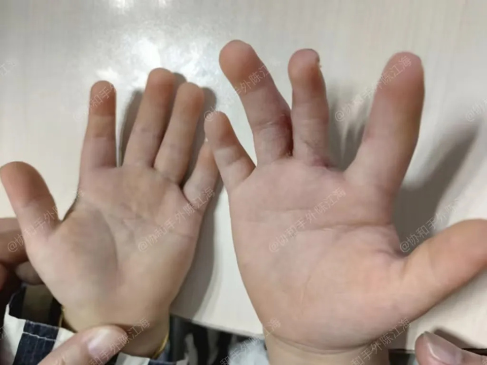 早产宝宝右手多指加并指,如今已经顺利张开五指了
