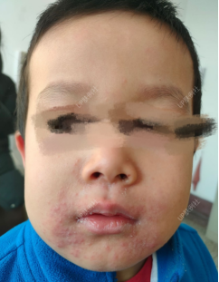 病例讨论|儿童肉芽肿性口周皮炎