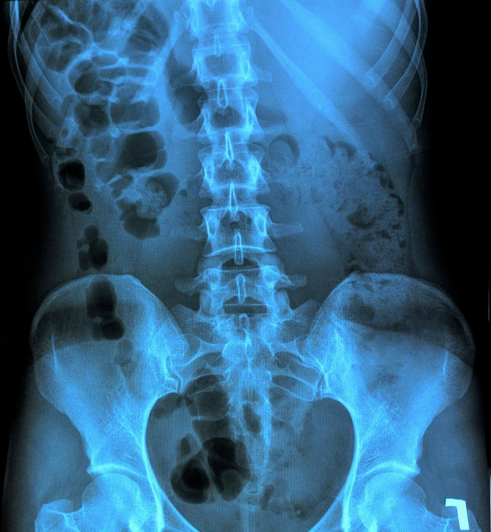 强直性脊柱炎检查全指南:从确诊到复查,这些都要知道!