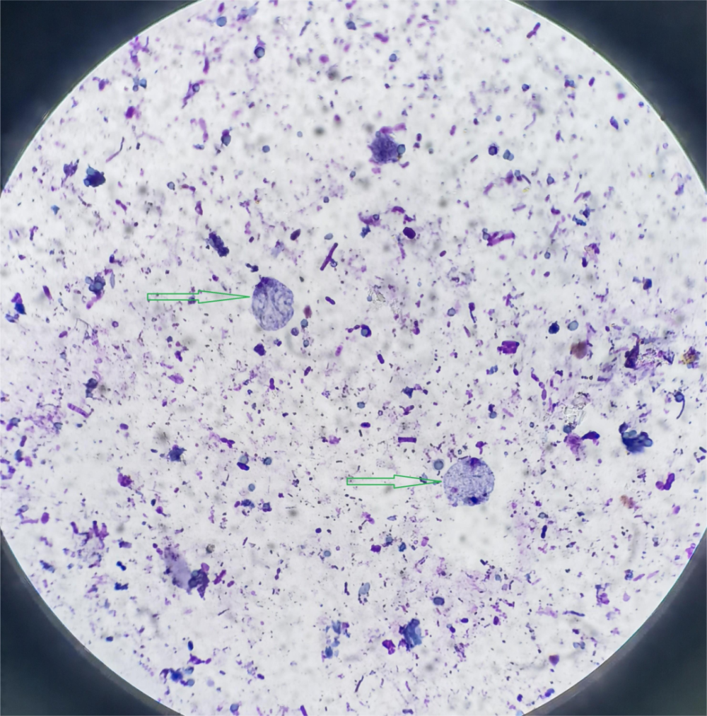 符合人芽囊原虫形态特点.