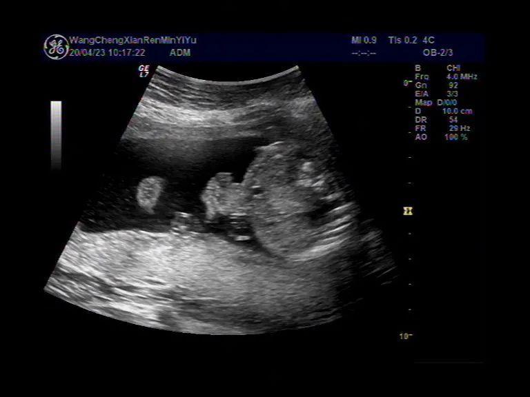 病例分享: 胎儿腹裂的病例你见过吗?