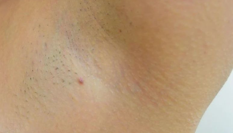 腋下发黑,暗沉,可能是身体发出的疾病信号!快自查