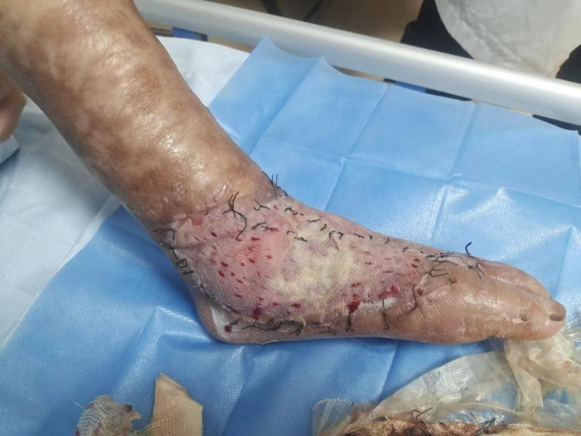 广西一女子干农活被五步蛇咬伤,溃烂感染.