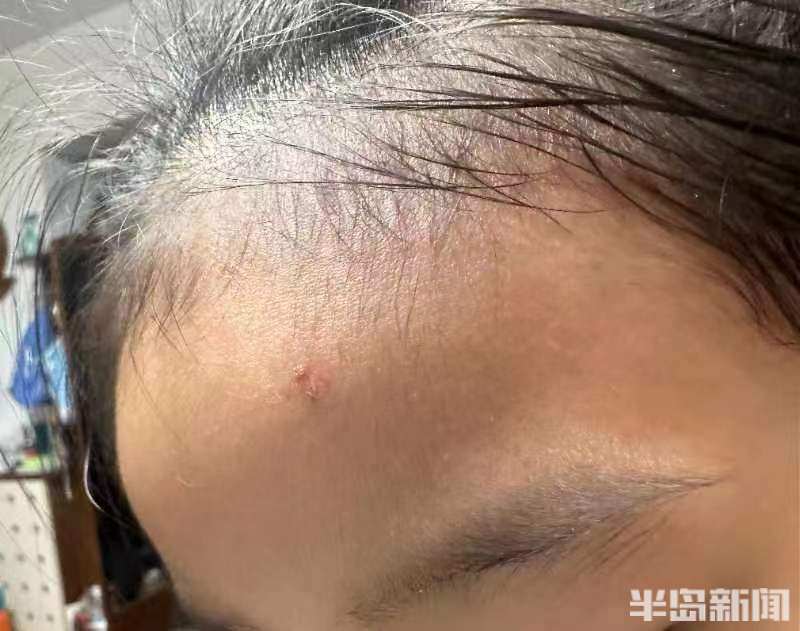 吃烤肉蹦出火星5岁女童脸上被烫伤