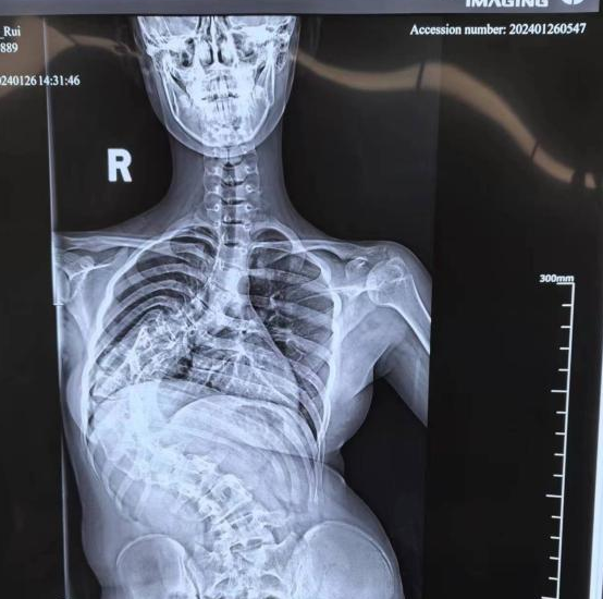 小叶医探 | 花季少女脊柱侧弯达130度,手术矫治使其长高11厘米